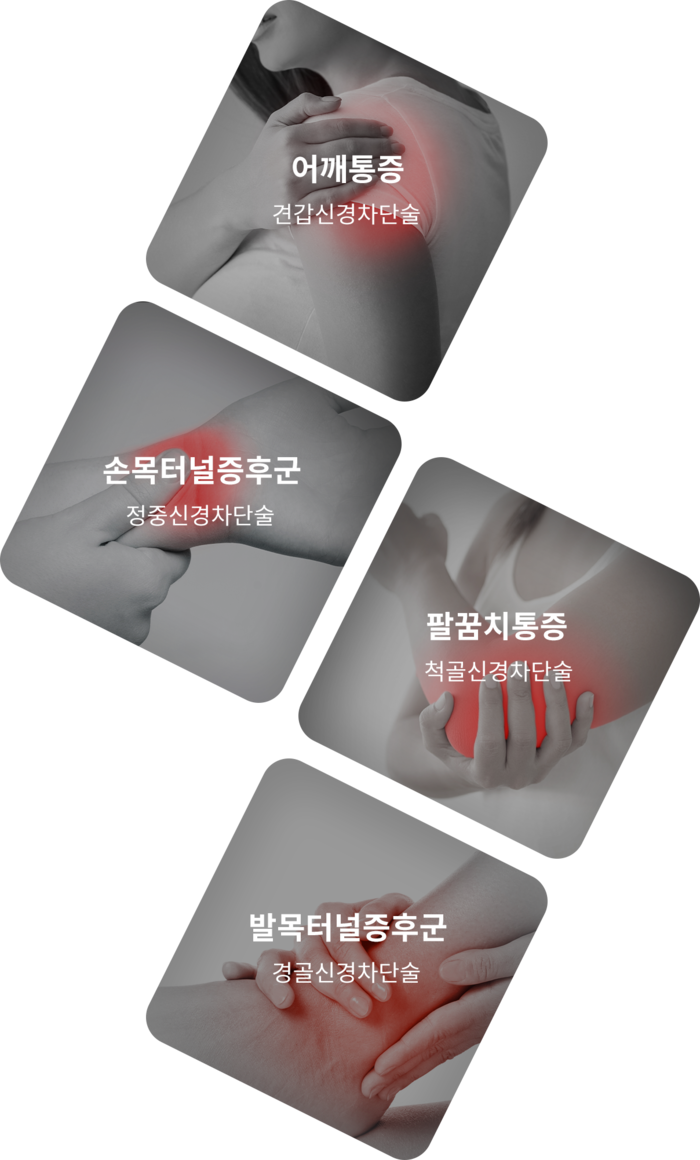 어깨통증 견갑신경차단술. 손목터널증후군 정중신경차단술. 팔꿈치통증 척골신경차단술. 발목터널증후군 경골신경차단술